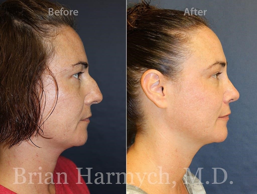 rhinoplasty surgery near me