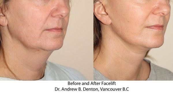 rhinoplasty surgery near me